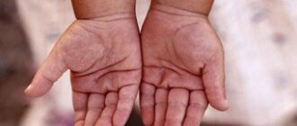 Цыпки на руках: лечение, как избавиться от цыпок у детей