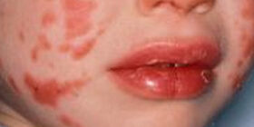 Симптомы и признаки, лечение болезни Кавасаки