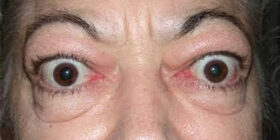 Гипертиреоз