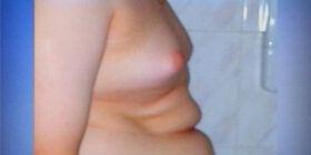 Гипогонадизм у мальчиков