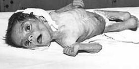 Гипотрофия