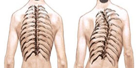 Идиопатический сколиоз