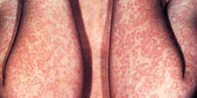 Симптомы и признаки, лечение инфекционной эритемы