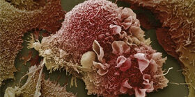 Инкурабельный рак