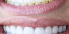 Как отбелить зубы в домашних условиях