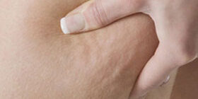 Какой крем от целлюлита хороший фото