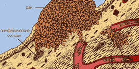 МЕТАСТАТИЧЕСКАЯ КАРЦИНОМА НЕИЗВЕСТНОГО ПЕРВИЧНОГО ПРОИСХОЖДЕНИЯ