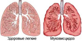 Муковисцидоз