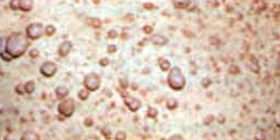 Диагностика и лечение нейрофиброматоза