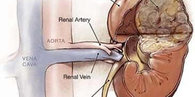 Опухоль Вильмса