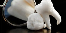 Осложнения после удаления зуба мудрости