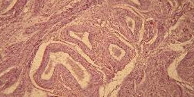 Паранеопластические синдромы