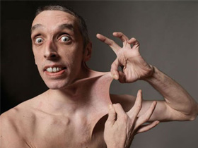 Синдром Элерса—Данлоса Синдром Элерса—Данлоса