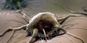 Стадирование опухоли