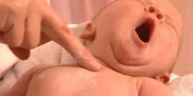 Симптомы и признаки, лечение судорожного синдрома у новорожденных