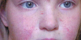 Симптомы и признаки, лечение туберозного склероза