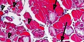 Врожденная гипофосфатазия