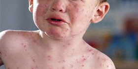 Врожденная краснуха