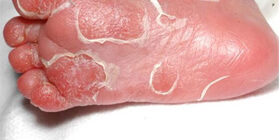 симптомы и признаки, лечение врожденного сифилиса у детей и профилактика. Поздний врожденный сифилис