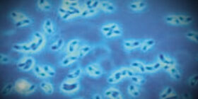 Врожденный токсоплазмоз