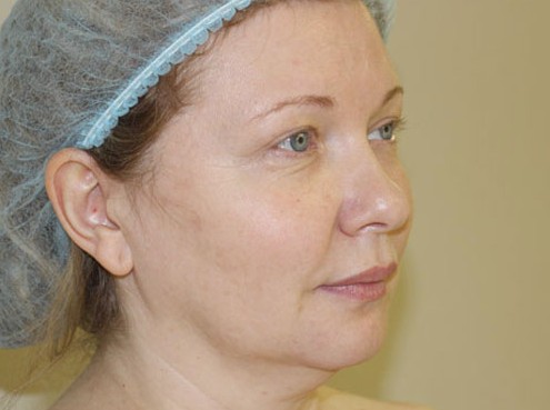 Лазерная подтяжка лица