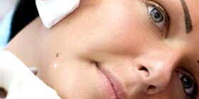 Опасные родинки