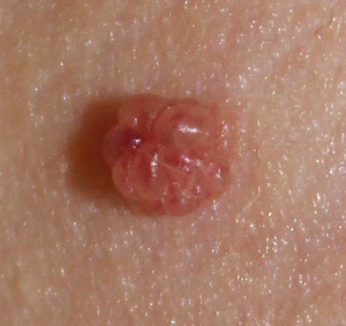 опасные родинки