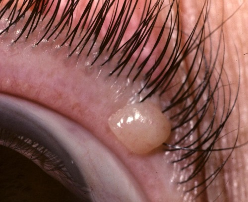 опасные родинки