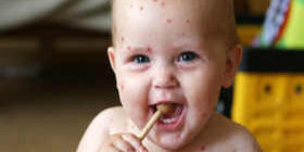 Ветрянка фото