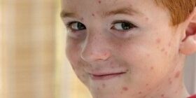 Ветрянка у детей и ее лечение